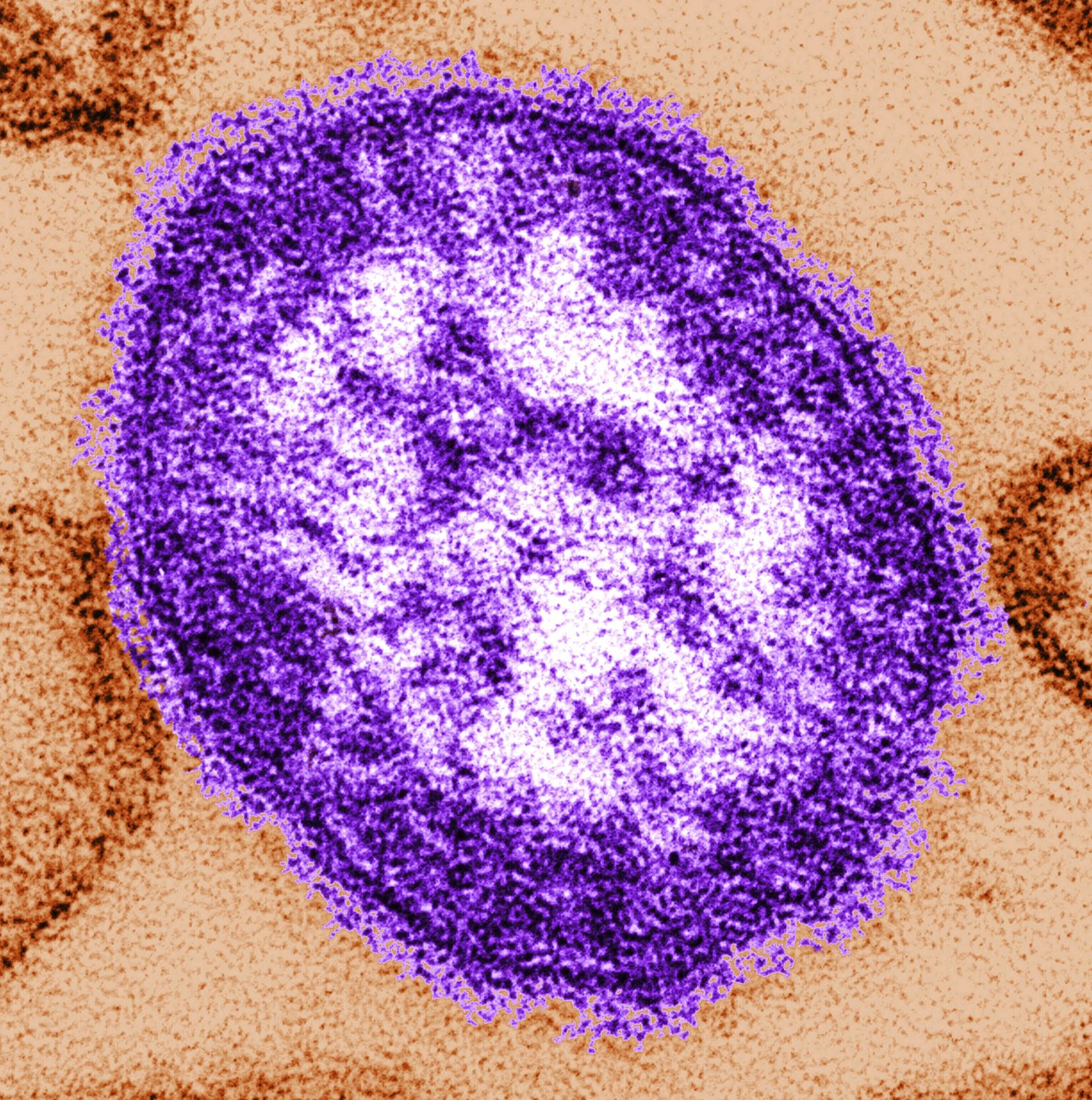 Quebec measles outbreak grows to 11 cases; officials warn of thousands of exposures | iNFOnews.ca