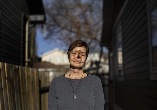 'I put life on hold:' Woman who had delayed surgery in Alberta says she's worse off | iNFOnews.ca 'I put life on hold:' Woman who had delayed surgery in Alberta says she's worse off | iNFOnews.ca