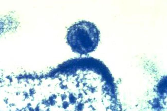 Study identifies virulent HIV variant unrecognized for years | iNFOnews.ca