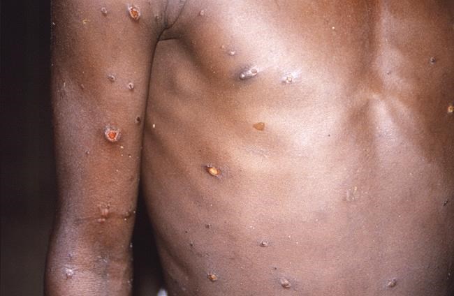 Africans see inequity in monkeypox response elsewhere | iNFOnews.ca Africans see inequity in monkeypox response elsewhere | iNFOnews.ca
