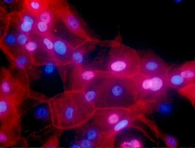 Some cancer patients can skip treatments, 2 studies show | iNFOnews.ca