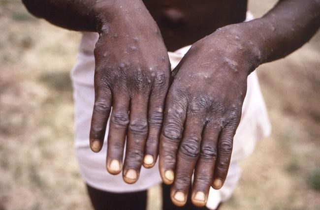 WHO to share vaccines to stop monkeypox amid inequity fears | iNFOnews.ca