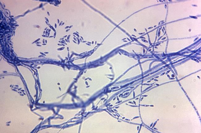 6 dead in a meningitis outbreak tied to Mexico clinics as officials struggle to reach more patients | iNFOnews.ca