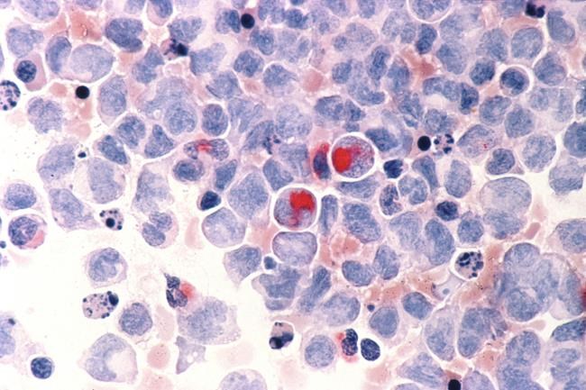 Progress in childhood cancer has stalled for Blacks and Hispanics, report says | iNFOnews.ca Progress in childhood cancer has stalled for Blacks and Hispanics, report says | iNFOnews.ca