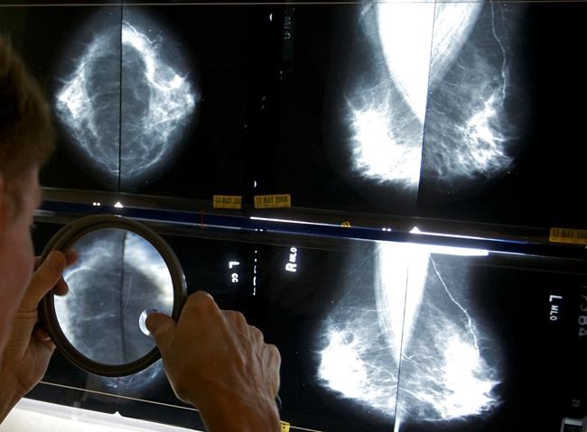 Breast cancer survivors may not need so many mammograms after surgery, UK study suggests | iNFOnews.ca Breast cancer survivors may not need so many mammograms after surgery, UK study suggests | iNFOnews.ca