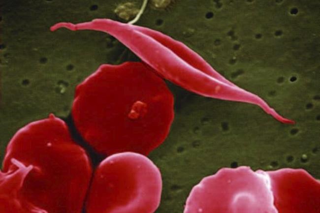 Sickle cell affects more families in Africa and India, but new gene therapies are out of reach | iNFOnews.ca Sickle cell affects more families in Africa and India, but new gene therapies are out of reach | iNFOnews.ca