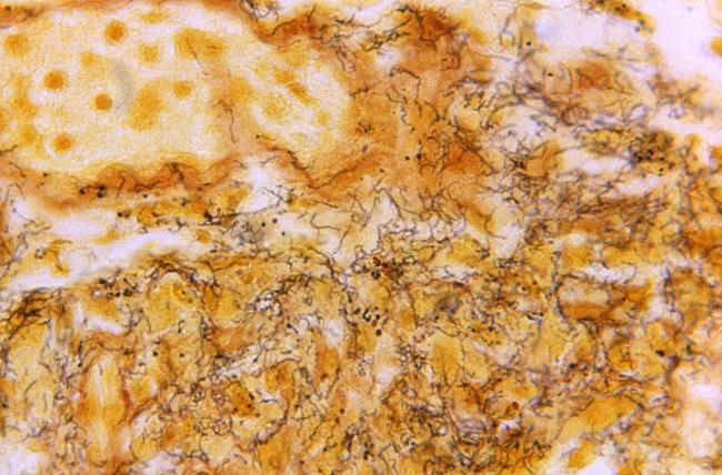 The US hasn't seen syphilis numbers this high since 1950. Other STD rates are down or flat | iNFOnews.ca The US hasn't seen syphilis numbers this high since 1950. Other STD rates are down or flat | iNFOnews.ca