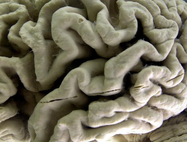 Silent brain changes precede Alzheimer's. Researchers have new clues about which come first | iNFOnews.ca