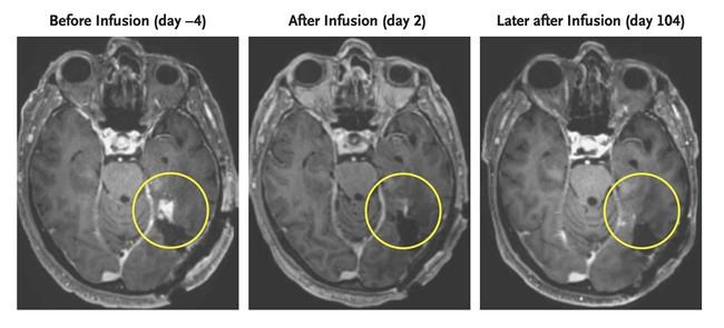 A new strategy to attack aggressive brain cancer shrank tumors in two early tests | iNFOnews.ca A new strategy to attack aggressive brain cancer shrank tumors in two early tests | iNFOnews.ca