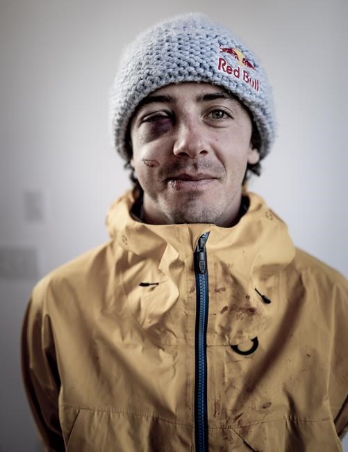 Canadian snowboarder Mark McMorris healing from kneeing himself in the face, surgery | iNFOnews.ca