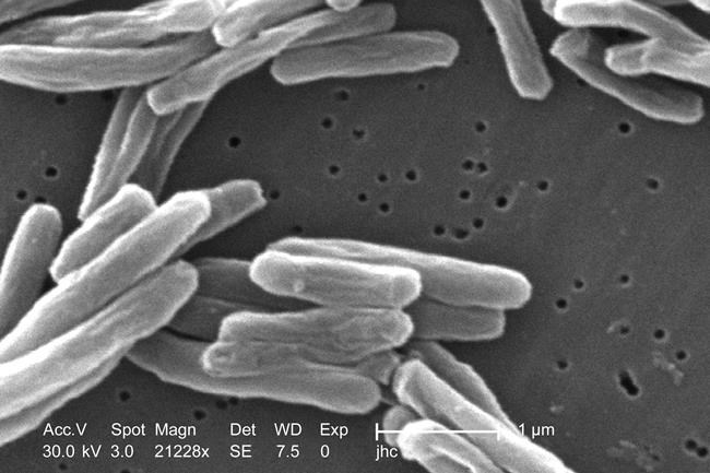 US tuberculosis cases were at the highest level in a decade in 2023 | iNFOnews.ca