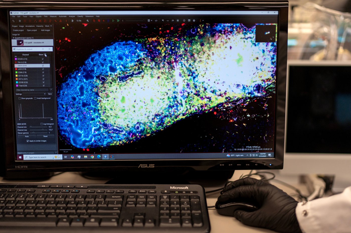 Lifelong drugs for autoimmune diseases don't work well. Now scientists are trying something new | iNFOnews.ca Lifelong drugs for autoimmune diseases don't work well. Now scientists are trying something new | iNFOnews.ca
