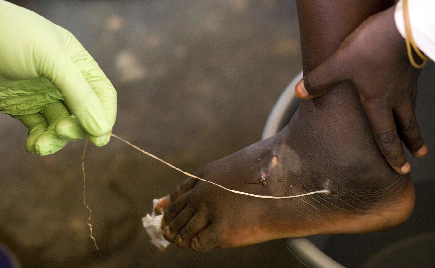 Jimmy Carter made eradicating Guinea worm disease a top mission | iNFOnews.ca Jimmy Carter made eradicating Guinea worm disease a top mission | iNFOnews.ca