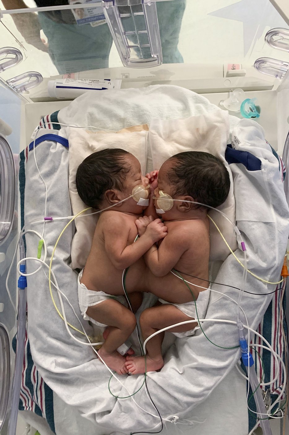 Twin boys born conjoined celebrate 1st birthday after separation surgery | iNFOnews.ca Twin boys born conjoined celebrate 1st birthday after separation surgery | iNFOnews.ca