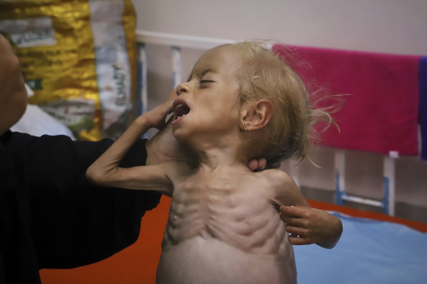 Malnourished kids arrive daily at a Gaza hospital as Netanyahu denies hunger | iNFOnews.ca Malnourished kids arrive daily at a Gaza hospital as Netanyahu denies hunger | iNFOnews.ca