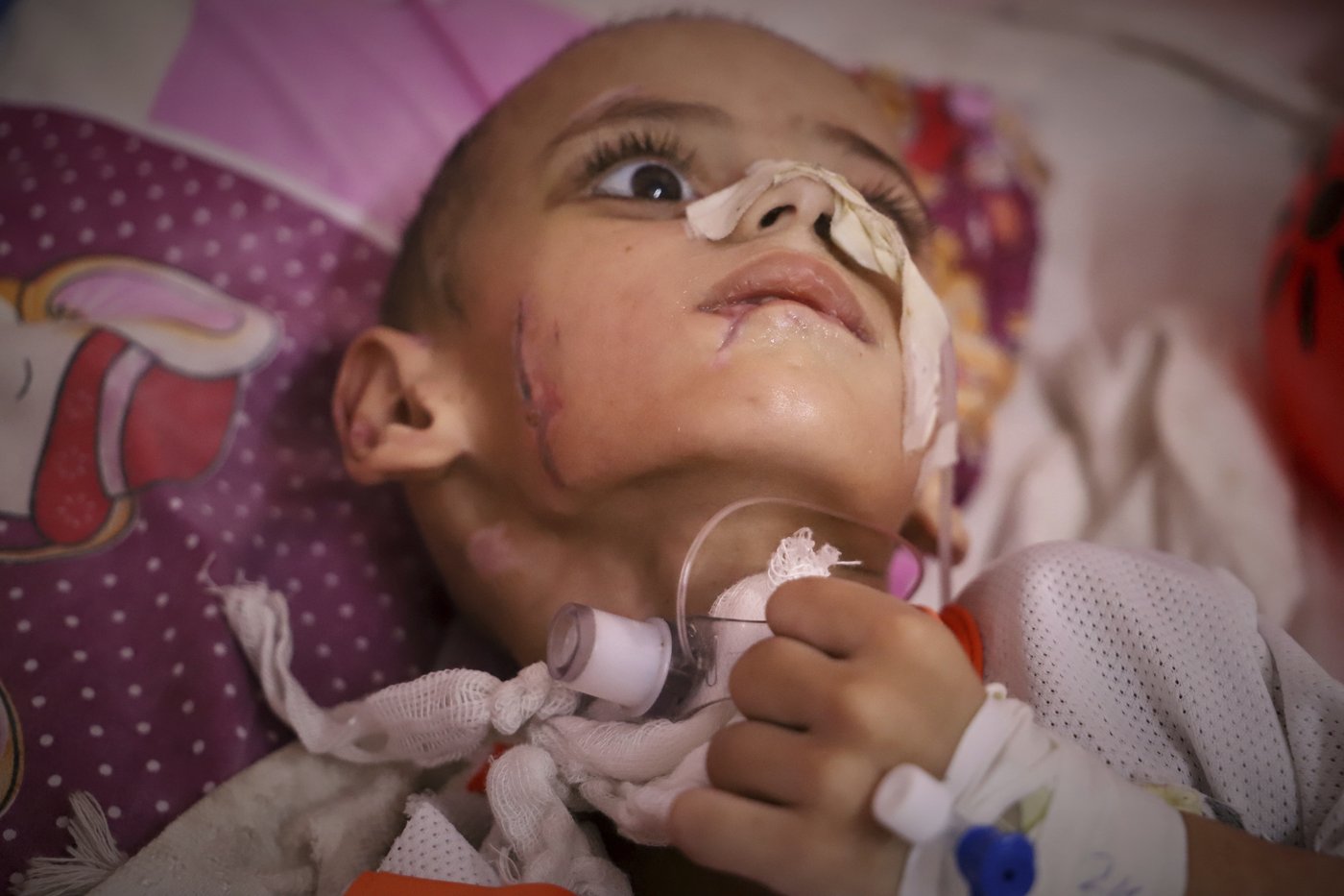 A boy with a brain injury fights for his life in Gaza's decimated health system | iNFOnews.ca