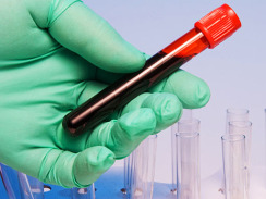 Blood type may signal heart disease risk; A, B, AB blood types linked to higher risk than O | iNFOnews.ca CP19788200