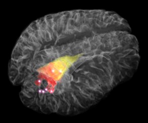 Fibre-optic device could advance brain tumour surgery, maybe boost survival: study | iNFOnews.ca CP31860049