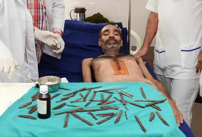 Doctors in India remove 40 knives from man's stomach | iNFOnews.ca