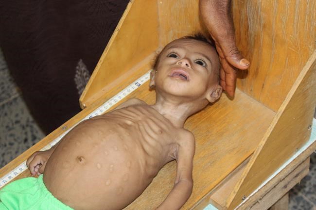 Hunger stalks children in Yemen as UN cuts aid programs | iNFOnews.ca Hunger stalks children in Yemen as UN cuts aid programs | iNFOnews.ca