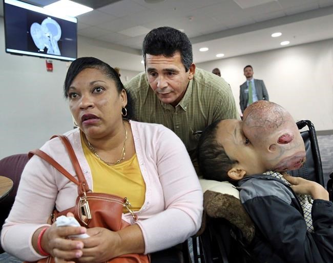 Cuban boy dies after surgery to remove 10-pound face tumour | iNFOnews.ca