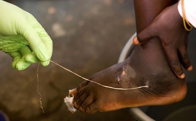 Guinea worm closer to eradication as cases halve in a year | iNFOnews.ca Guinea worm closer to eradication as cases halve in a year | iNFOnews.ca