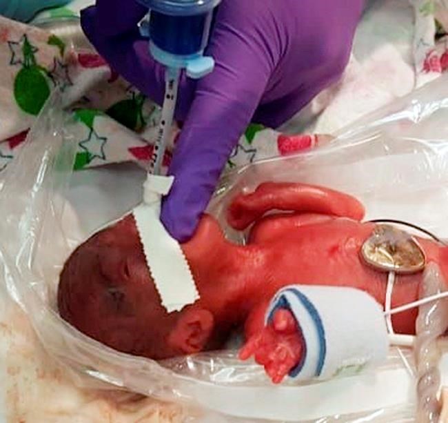 Girl believed to be tiniest newborn weighed as much as apple | iNFOnews.ca