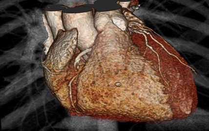Study questions heart imaging; CT scans and older tests prove equally effective for chest pain | iNFOnews.ca Study questions heart imaging; CT scans and older tests prove equally effective for chest pain | iNFOnews.ca