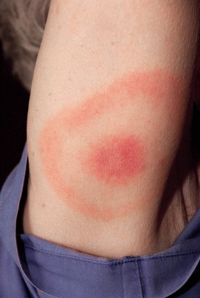 From urine therapy to vitamins: study warns of untested Lyme disease 'cures' | iNFOnews.ca