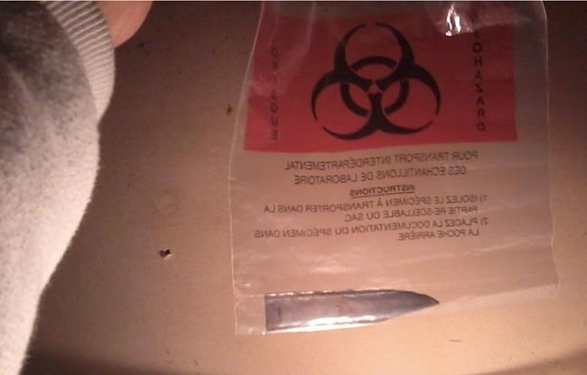 Man finds knife blade in back three years after stabbing | iNFOnews.ca Man finds knife blade in back three years after stabbing | iNFOnews.ca