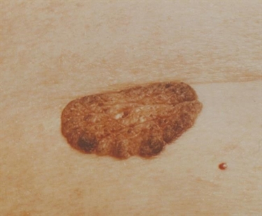 Sun spots, age spots: Is there anything you can do to stop brown skin patches? | iNFOnews.ca Sun spots, age spots: Is there anything you can do to stop brown skin patches? | iNFOnews.ca