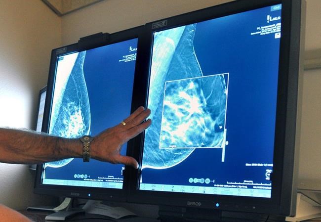 American Cancer Society says start screening mammograms at 45, not 40 because of false alarms | iNFOnews.ca