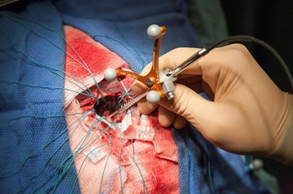 Fibre-optic device can detect stray cancer cells, improve tumour removal: study | iNFOnews.ca