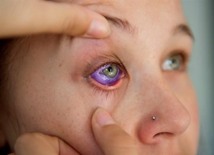 Eyeball tattoos could lead to blindness and severe infections, doctors warn | iNFOnews.ca Eyeball tattoos could lead to blindness and severe infections, doctors warn | iNFOnews.ca