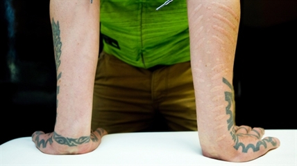 Scarification, an alternative to tattoos | iNFOnews.ca Scarification, an alternative to tattoos | iNFOnews.ca
