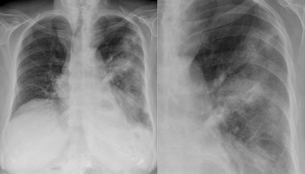 Fraser Health investigating outbreak of Legionnaires' disease in Surrey, B.C. | iNFOnews.ca Fraser Health investigating outbreak of Legionnaires' disease in Surrey, B.C. | iNFOnews.ca