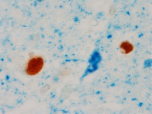 Scientists tie new protein to Alzheimer's disease; may aid diagnosis, research on treatments | iNFOnews.ca CP29151489