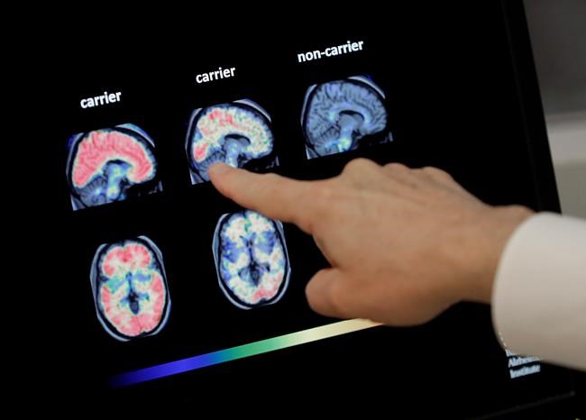 Medicare coverage for Alzheimer brain scans in question | iNFOnews.ca