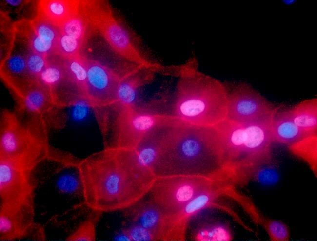 Immunotherapy scores a first win against some breast cancers | iNFOnews.ca CP682342242