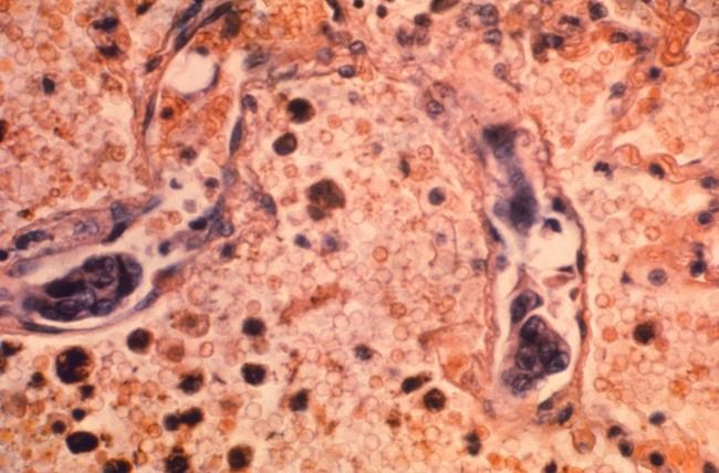Another record decline reported in US cancer death rate | iNFOnews.ca Another record decline reported in US cancer death rate | iNFOnews.ca