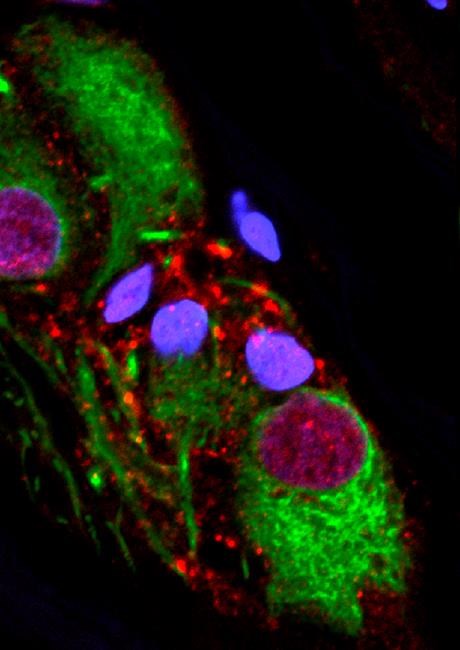Appendix removal is linked to lower risk of Parkinson's | iNFOnews.ca Appendix removal is linked to lower risk of Parkinson's | iNFOnews.ca