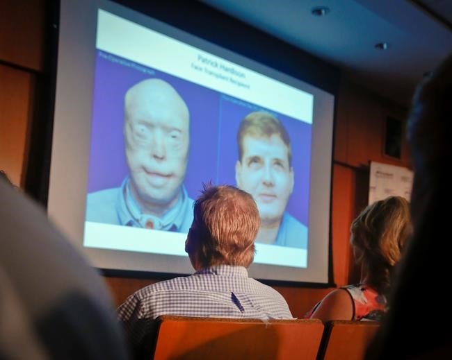 Are face transplants still research, or regular care? | iNFOnews.ca