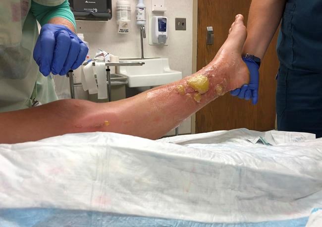 Poison parsnip causes severe burns, blisters on woman's legs | iNFOnews.ca Poison parsnip causes severe burns, blisters on woman's legs | iNFOnews.ca
