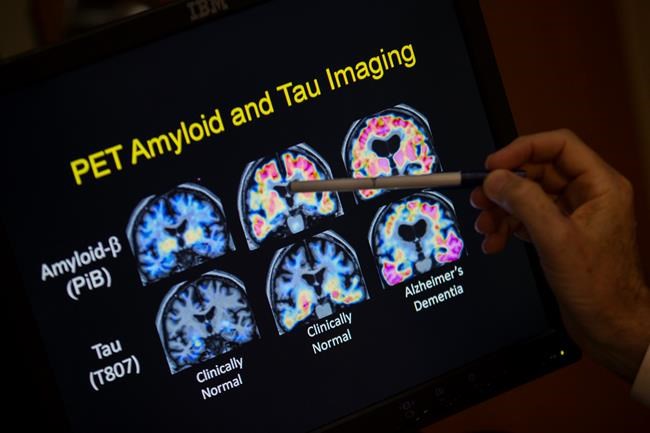 New way of defining Alzheimer's aims to find disease sooner | iNFOnews.ca