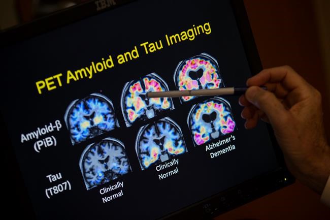 Report finds few seniors are getting routine memory checkups | iNFOnews.ca