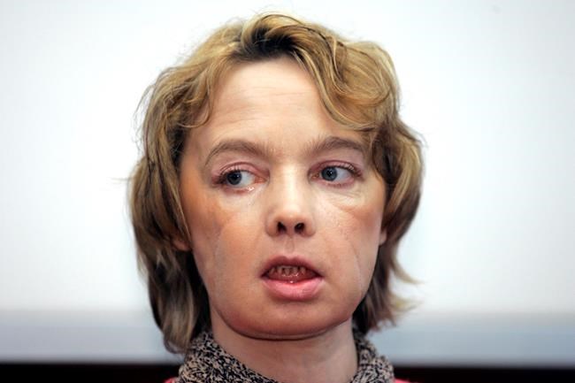 Frenchwoman who got world's 1st face transplant dies at 49 | iNFOnews.ca