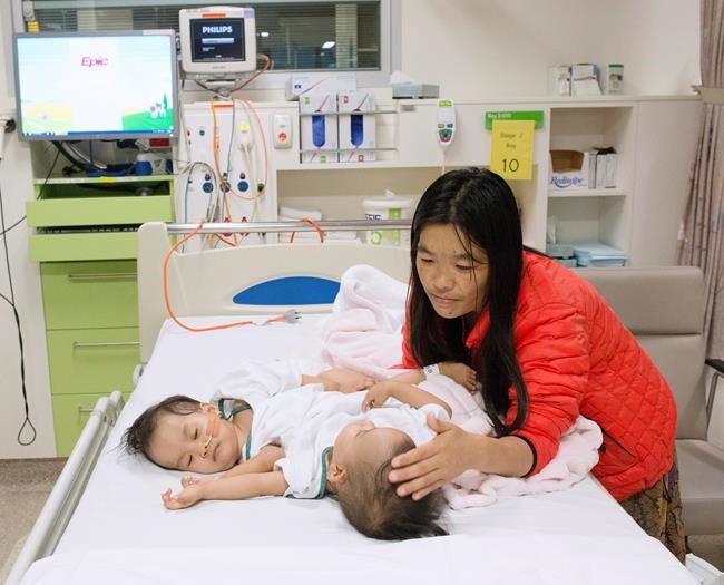 Surgeons in Australia separate conjoined girls from Bhutan | iNFOnews.ca