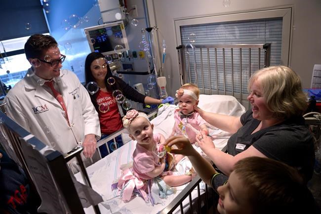 Conjoined twins separated at Houston hospital discharged | iNFOnews.ca Conjoined twins separated at Houston hospital discharged | iNFOnews.ca