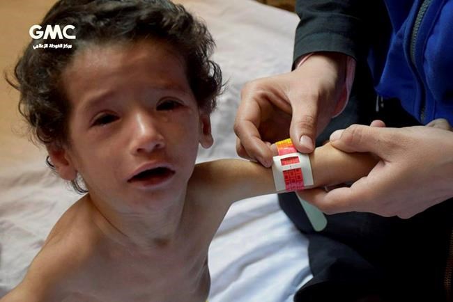UN: Worst malnutrition since war is in besieged Syria suburb | iNFOnews.ca UN: Worst malnutrition since war is in besieged Syria suburb | iNFOnews.ca