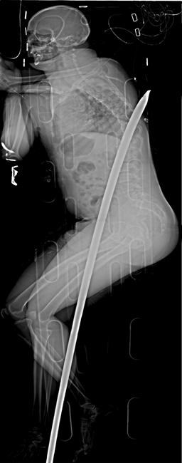 South African man who survived impaling to run ultramarathon | iNFOnews.ca